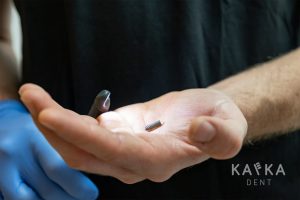 Zubný implantát Kafka Dent, Cena zubných implantátov? Tá naša je konečná a bez skrytých položiek