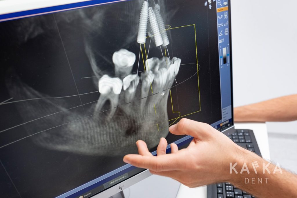 Vizualizácia zubné implantáty