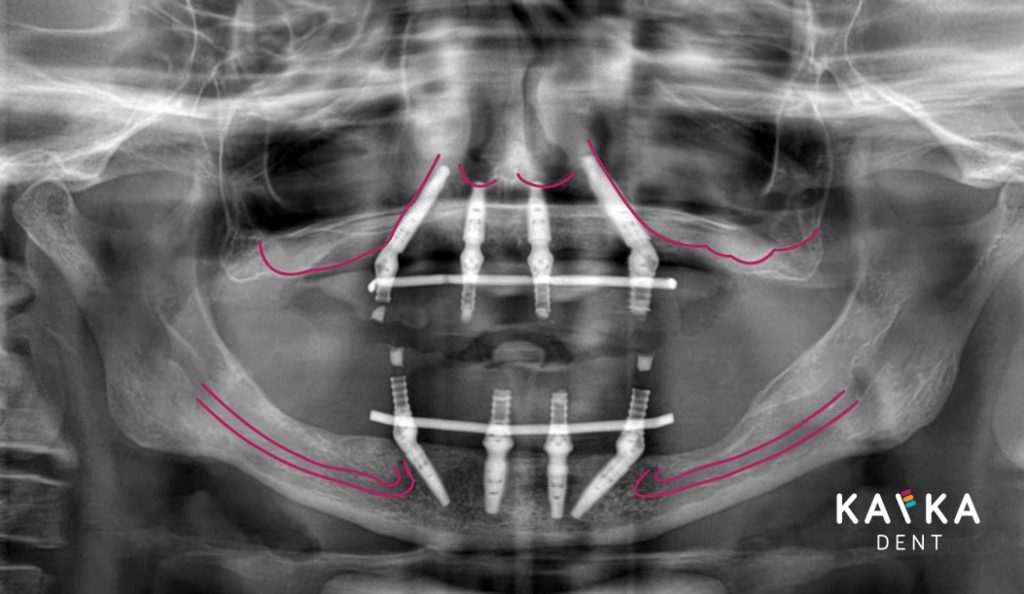 RTG snímok rozloženia zubných implantátov v čelusti