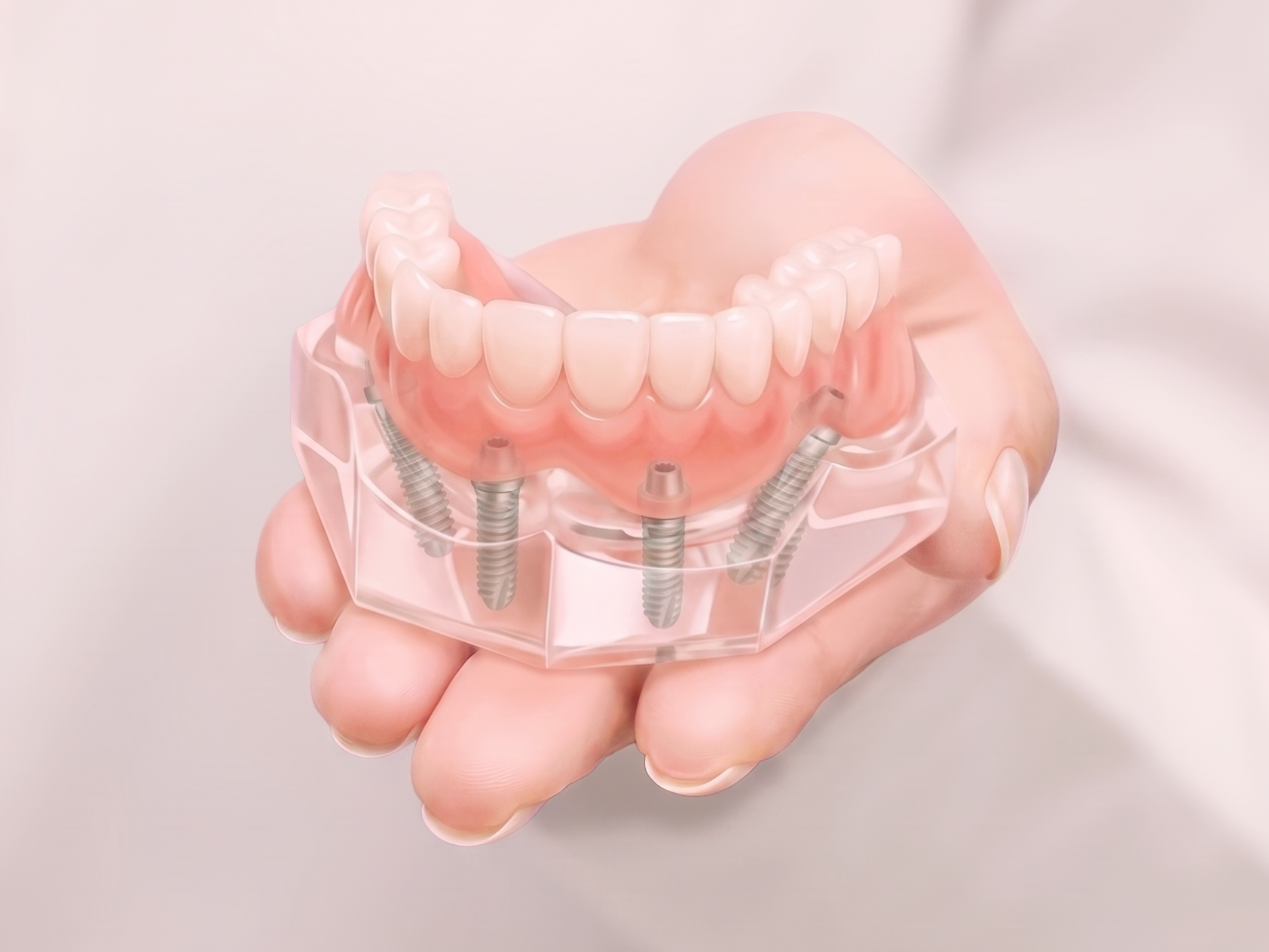 Fixná zubná náhrada All-on-4 uchytená na štyroch zubných implantátoch v klinike Kafka Dent.