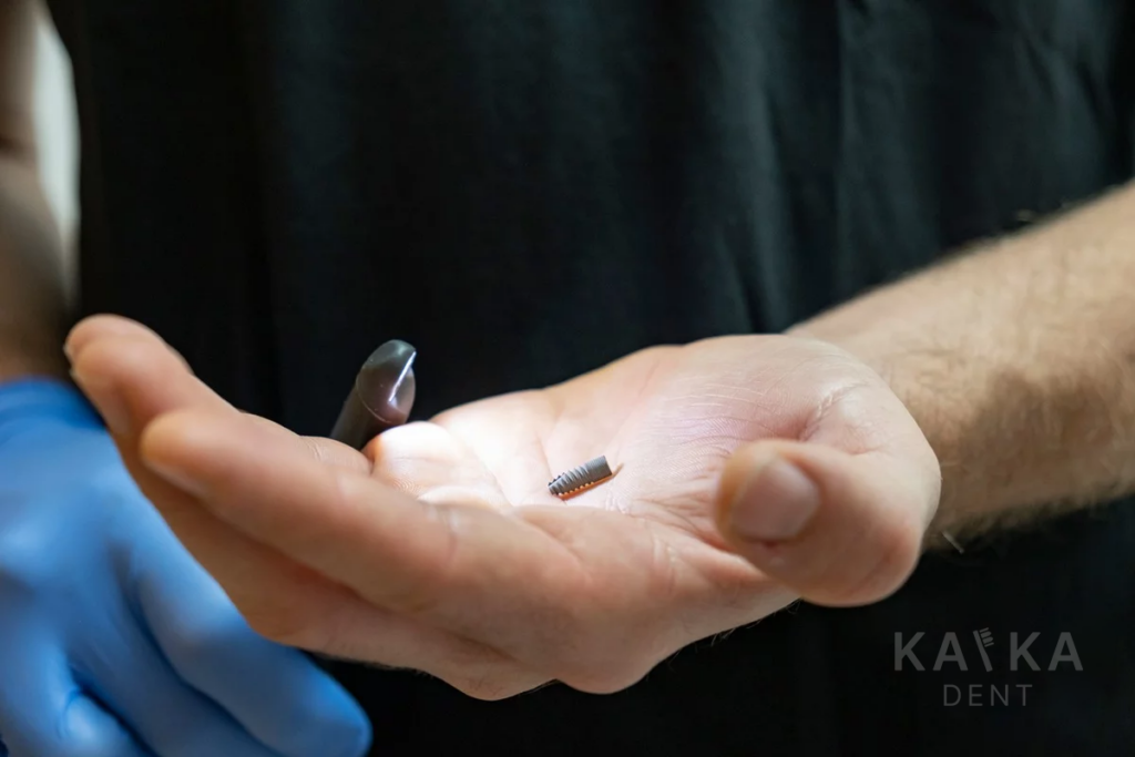 Kvalitny Zubny Implantat Kafka Dent Bratislava